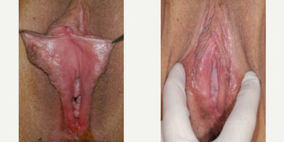 Case 10109 - Woman treated with Labiaplasty