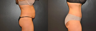 Case 1011 - Woman treated with Tummy Tuck