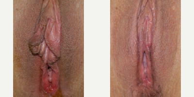 Case 10110 - Woman treated with Labiaplasty