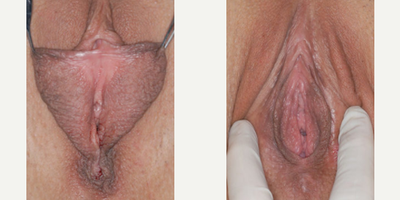 Case 10111 - Woman treated with Labiaplasty