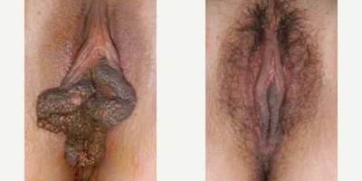 Case 10112 - Woman treated with Labiaplasty