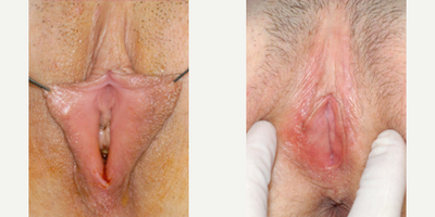 Case 10113 - Woman treated with Labiaplasty