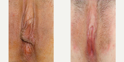 Case 10114 - Woman treated with Labiaplasty