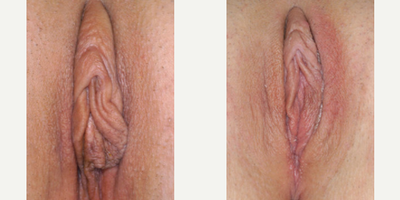 Case 10115 - Woman treated with Labiaplasty