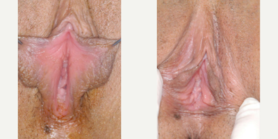 Case 10116 - Woman treated with Labiaplasty