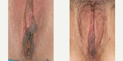Case 10119 - Woman treated with Labiaplasty