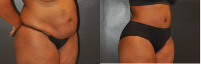 Case 1012 - Woman treated with Tummy Tuck