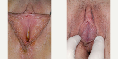 Case 10120 - Woman treated with Labiaplasty