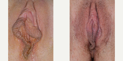 Case 10121 - Woman treated with Labiaplasty