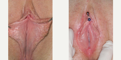 Case 10122 - Woman treated with Labiaplasty
