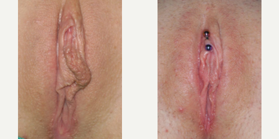 Case 10124 - Woman treated with Labiaplasty