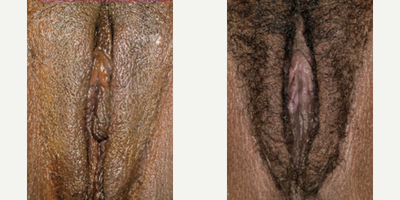 Case 10125 - Woman treated with Labiaplasty