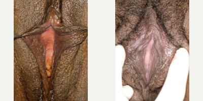 Case 10126 - Woman treated with Labiaplasty