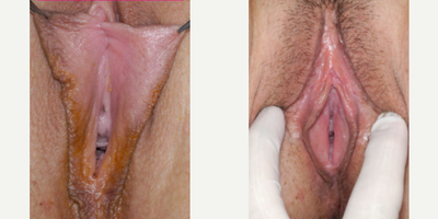 Case 10127 - Woman treated with Labiaplasty