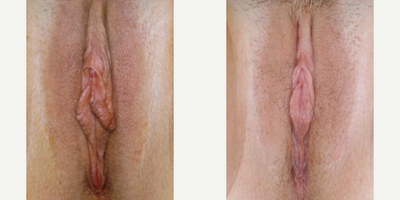 Case 10128 - Woman treated with Labiaplasty