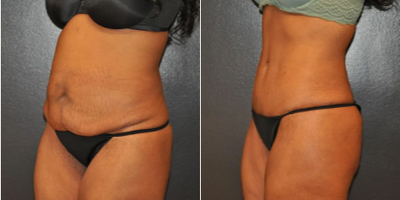 Case 1013 - Woman treated with Tummy Tuck