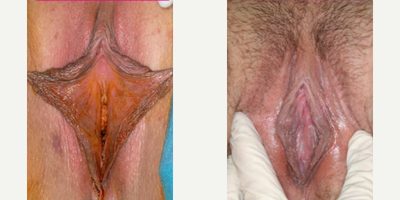 Case 10132 - Woman treated with Labiaplasty