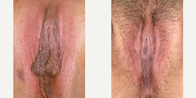 Case 10133 - Woman treated with Labiaplasty