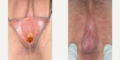 Case 10135 - Woman treated with Labiaplasty