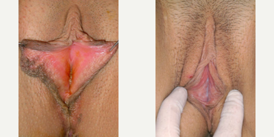 Case 10136 - Woman treated with Labiaplasty