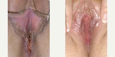 Case 10138 - Woman treated with Labiaplasty