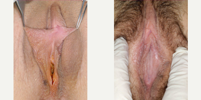 Case 10139 - Woman treated with Labiaplasty
