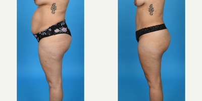 Case 1014 - 35-44 year old woman treated with Abdominal Etching, Diastasis Recti Repair, Drainless Tummy Tuck, Liposculpture, Liposuction, T