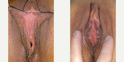 Case 10140 - Woman treated with Labiaplasty