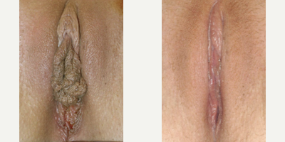 Case 10141 - Woman treated with Labiaplasty