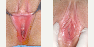 Case 10142 - Woman treated with Labiaplasty