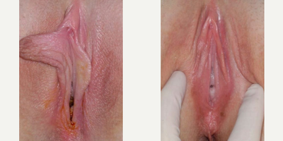 Case 10143 - Woman treated with Labiaplasty