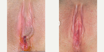 Case 10144 - Woman treated with Labiaplasty