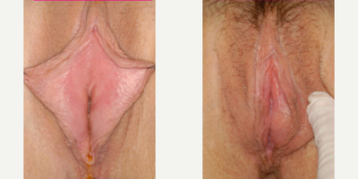 Case 10145 - Woman treated with Labiaplasty