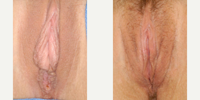 Case 10146 - Woman treated with Labiaplasty