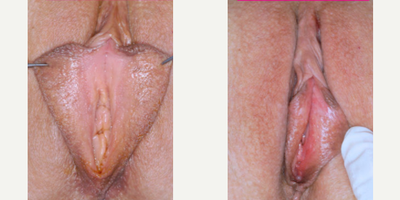 Case 10147 - Woman treated with Labiaplasty