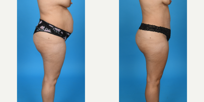 Case 1015 - 35-44 year old woman treated with Abdominal Etching, Diastasis Recti Repair, Drainless Tummy Tuck, Liposculpture, Liposuction, T