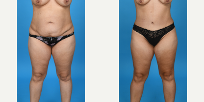 Case 1018 - 35-44 year old woman treated with Abdominal Etching, Diastasis Recti Repair, Drainless Tummy Tuck, Liposculpture, Liposuction, T