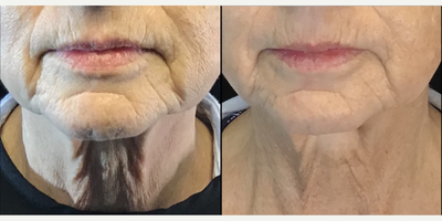 Case: 10191 - before and after photo of 65-74 year old woman treated with Ultherapy by James Mirabile, MD, FACOG