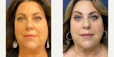 Case: 10192 - before and after photo of Woman treated with Liposuction, Ultherapy, Morpheus8, Voluma by Jennifer Reichel, MD