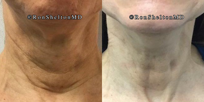 Case: 10193 - before and after photo of 65-74 year old woman treated with Ultherapy, Sofwave, Neck Lift, Skin Tightening by Ron Shelton, MD