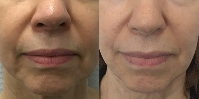 Case: 10194 - before and after photo of 65-74 year old woman treated with Sofwave, Ultherapy, Skin Tightening by Ron Shelton, MD