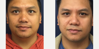 Case: 10195 - before and after photo of Man treated with Liposuction, FaceTite, Ultherapy by Jennifer Reichel, MD