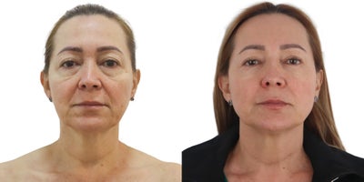 Case: 10196 - before and after photo of 45-54 year old woman treated with Ultherapy by Alan Gonzalez, MD, FACS