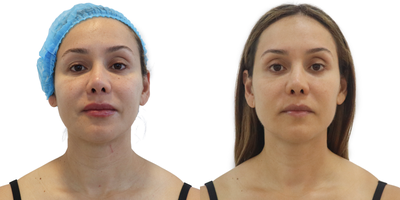 Case: 10197 - before and after photo of 45-54 year old woman treated with Ultherapy by Alan Gonzalez, MD, FACS