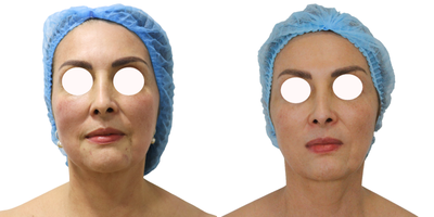 Case: 10198 - before and after photo of 45-54 year old woman treated with Ultherapy by Alan Gonzalez, MD, FACS
