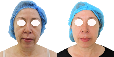 Case: 10199 - before and after photo of 45-54 year old woman treated with Ultherapy by Alan Gonzalez, MD, FACS