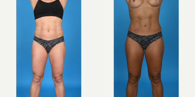 Case 102 - 35-44 year old woman treated with Abdominal Etching, BodyTite, Diastasis Recti Repair, Drainless Tummy Tuck, Liposculpture, Lipo