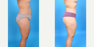 Case 1020 - 35-44 year old woman treated with Abdominal Etching, Diastasis Recti Repair, Drainless Tummy Tuck, Liposculpture, Liposuction, M