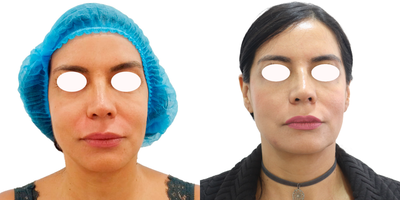 Case 10200 - 35-44 year old woman treated with Ultherapy