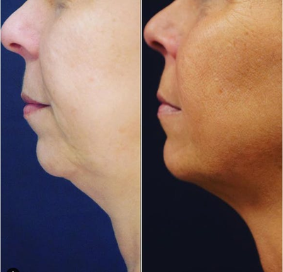 Case 10201 - Woman treated with Ultherapy